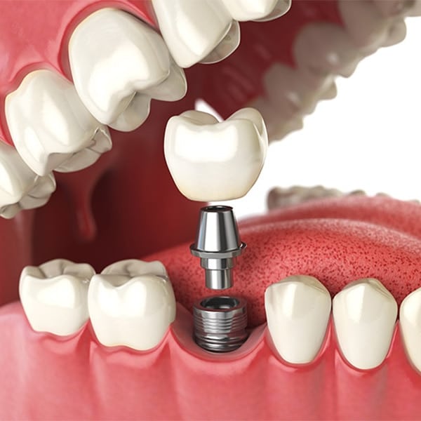 canyon state dental chandler az patient education bone graft for dental implants