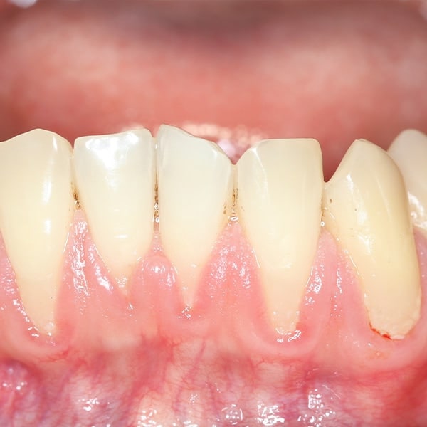 canyon state dental chandler az patient education gums receding
