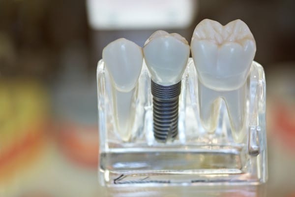 Dental Implants Chandler, AZ