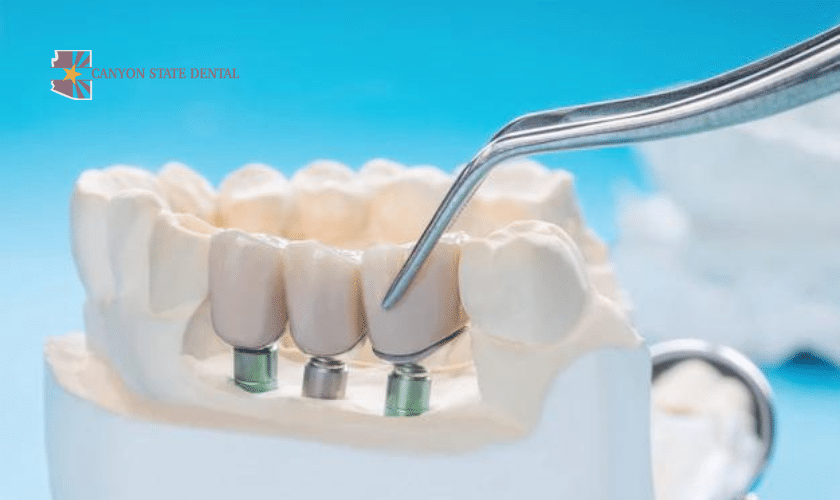 Know About Implant-Supported Dentures