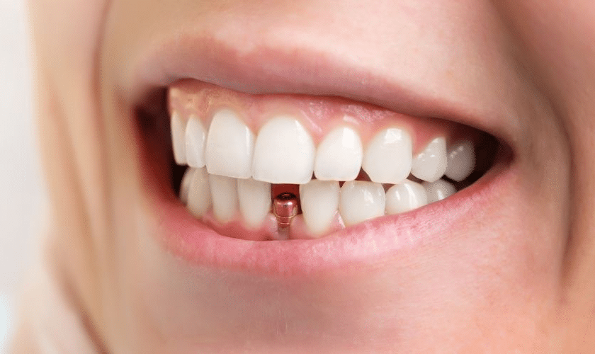 Dental Implants in Chandler