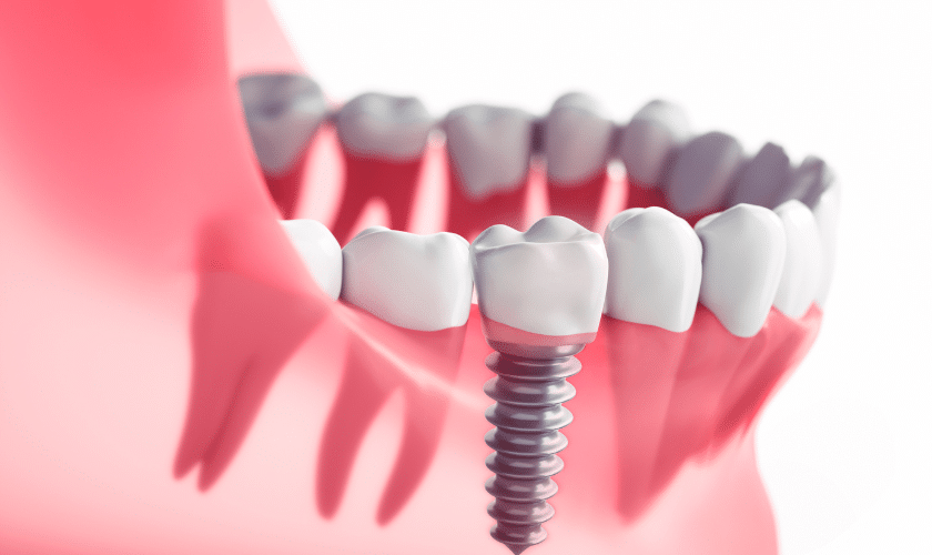 Dental implants with this independence day in Chander