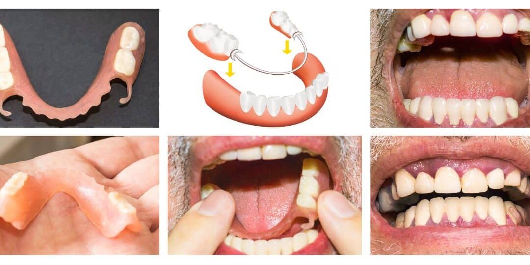What Do Lower and Upper Partial Dentures Look Like?