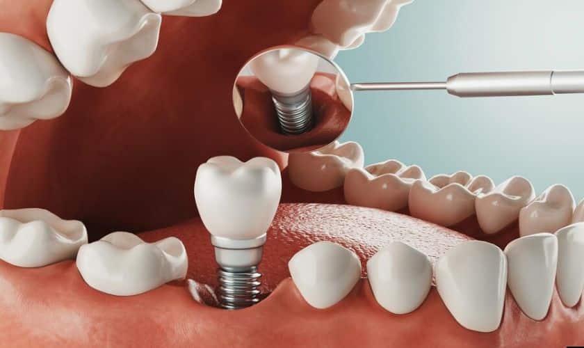 Is it Possible to Get Dental Implants in a Single Day?