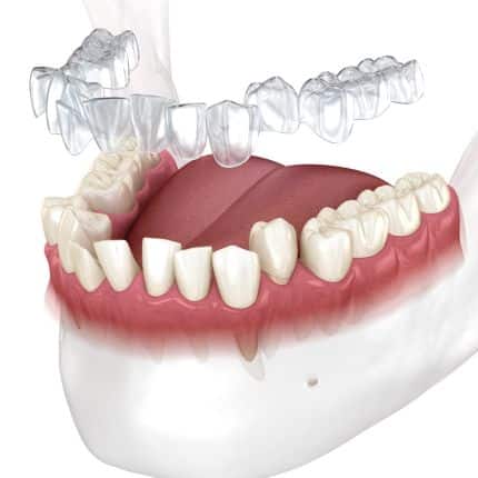 Invisalign in Chandler, AZ