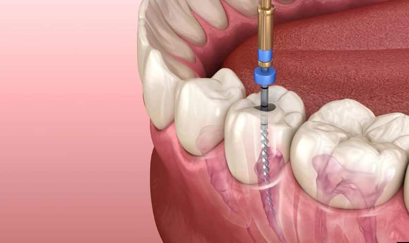 Do Root Canals Contribute to Chronic Health Issues?