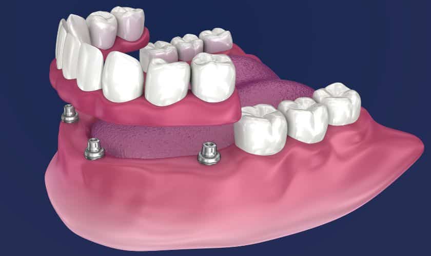 How Many Dental Implants Do You Need for a Full Set of Teeth?