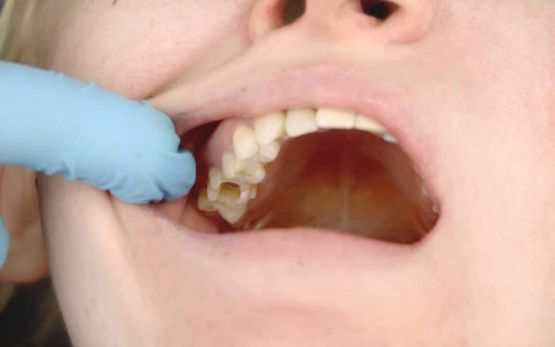 The Hidden Dangers of Tooth Cavities: How Serious Can They Really Get?