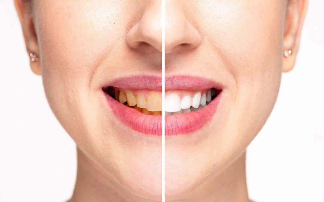 How to Get Rid of Yellow Teeth: Expert Tips from a Dentist in Chandler