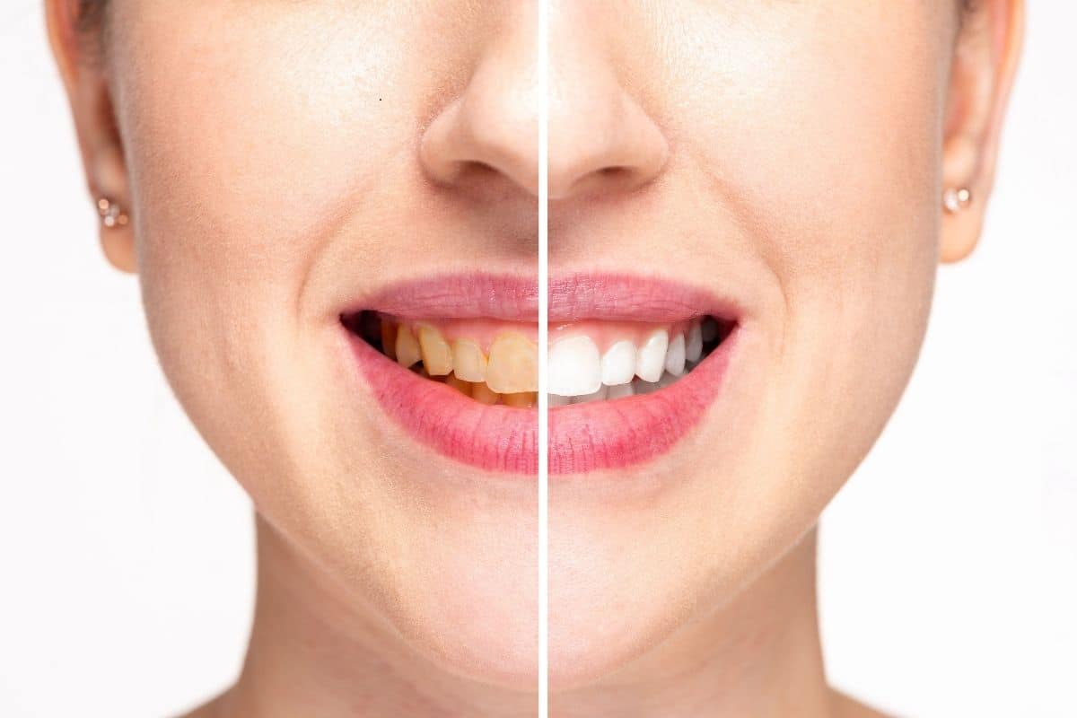 Teeth Whitening in Chandler