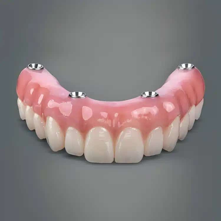 all on 4 dental implants