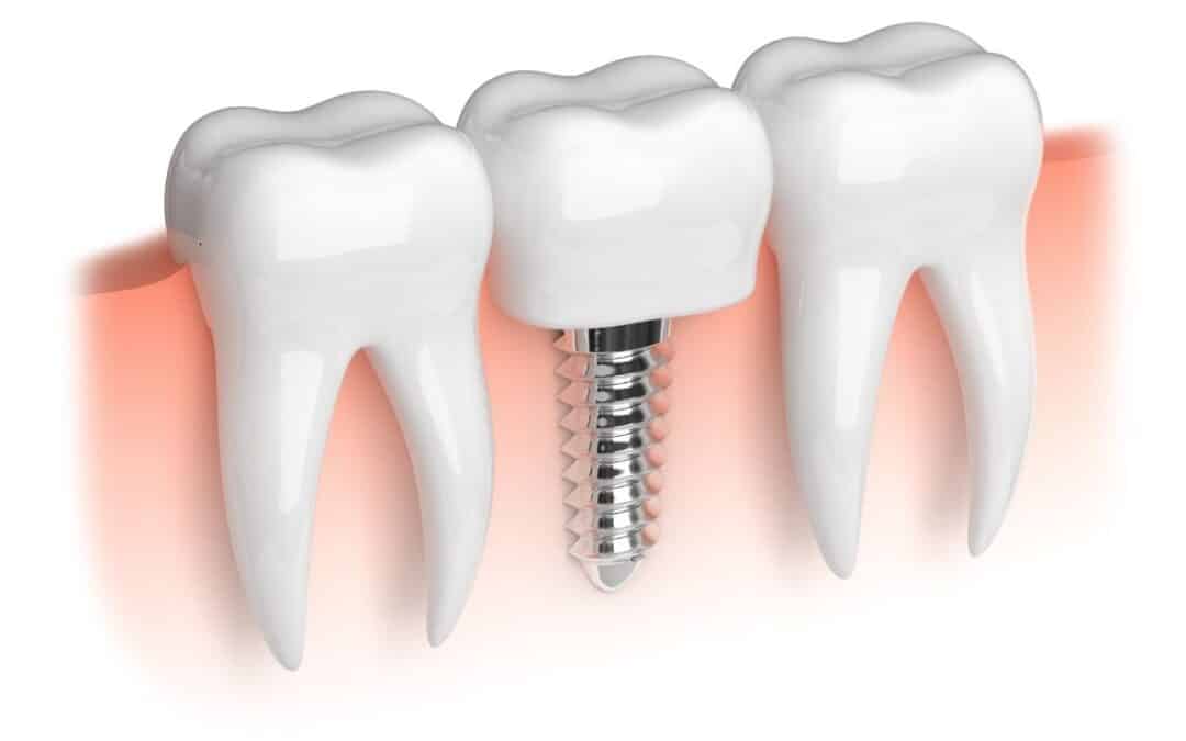 Key Benefits of Choosing Dental Implants Instead of Traditional Dentures