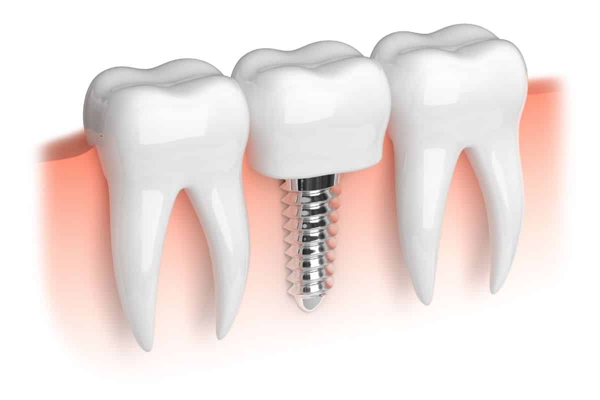 Dental Implants