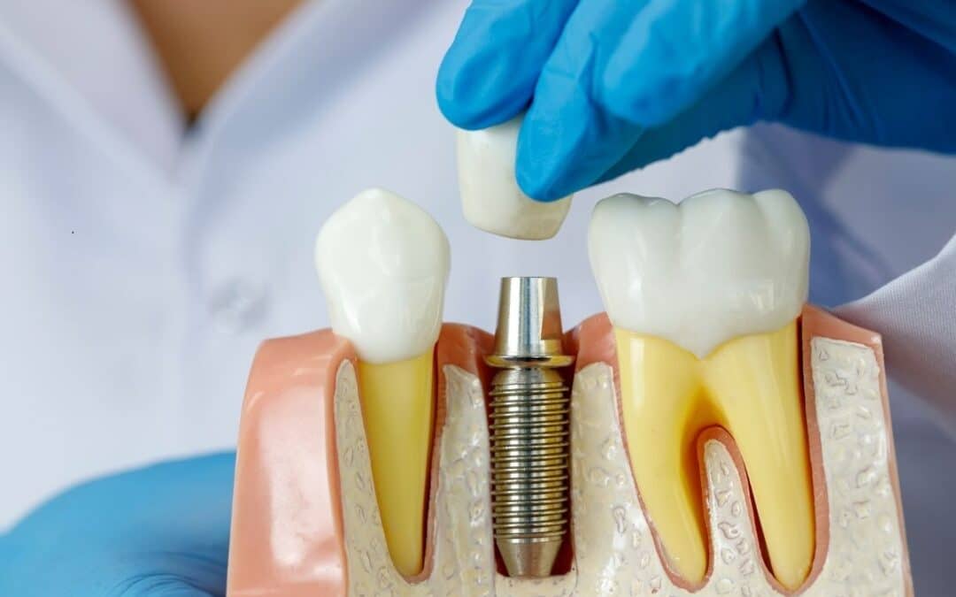 The Benefits of Choosing Dental Implants Over Traditional Dentures