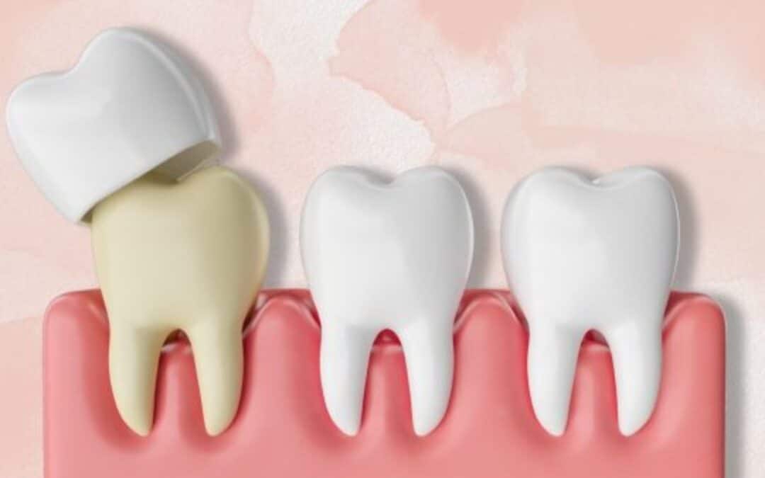 How Long Do Dental Crowns Last? Tips for Extending Their Lifespan