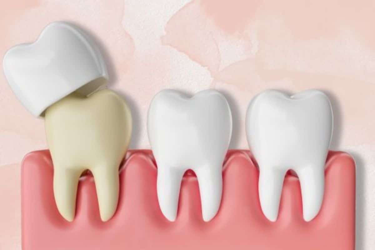 dental crowns chandler