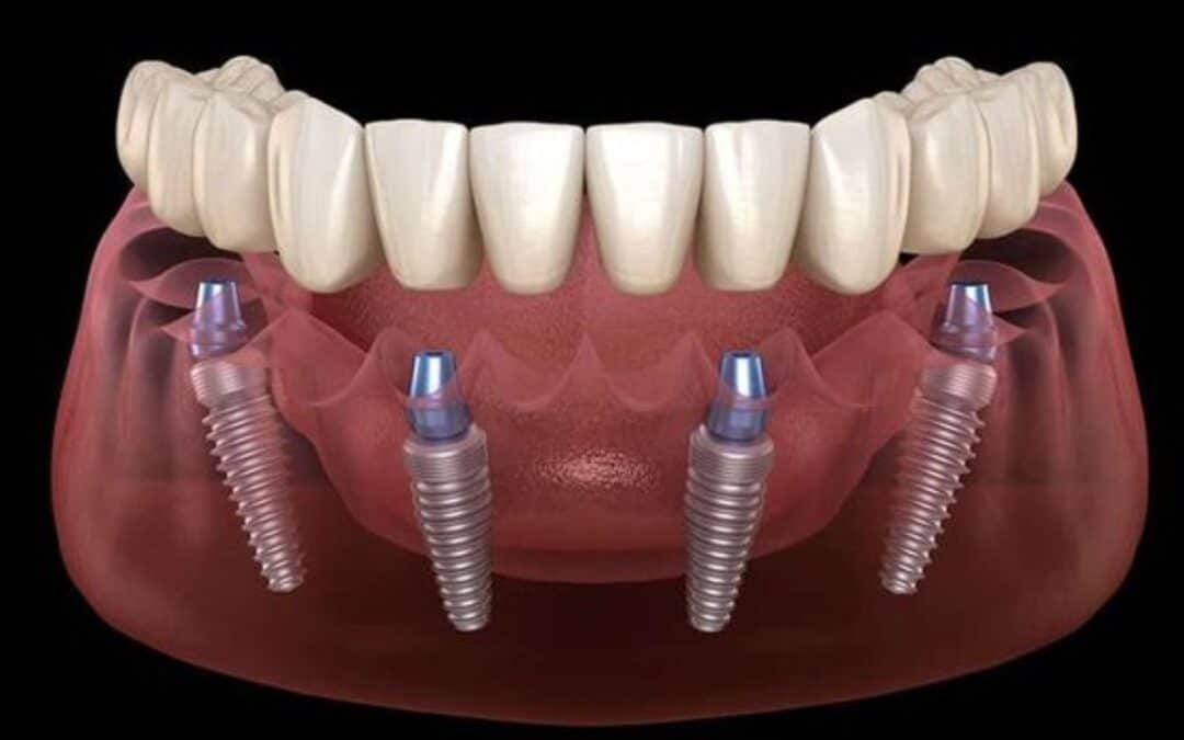 The Benefits of Choosing All-on-4 Implants Over Dentures