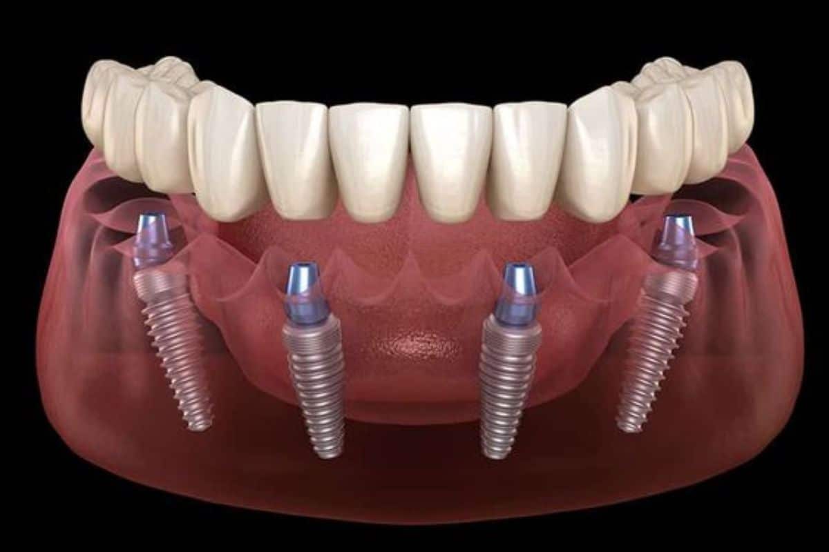 all on 4 dental implants