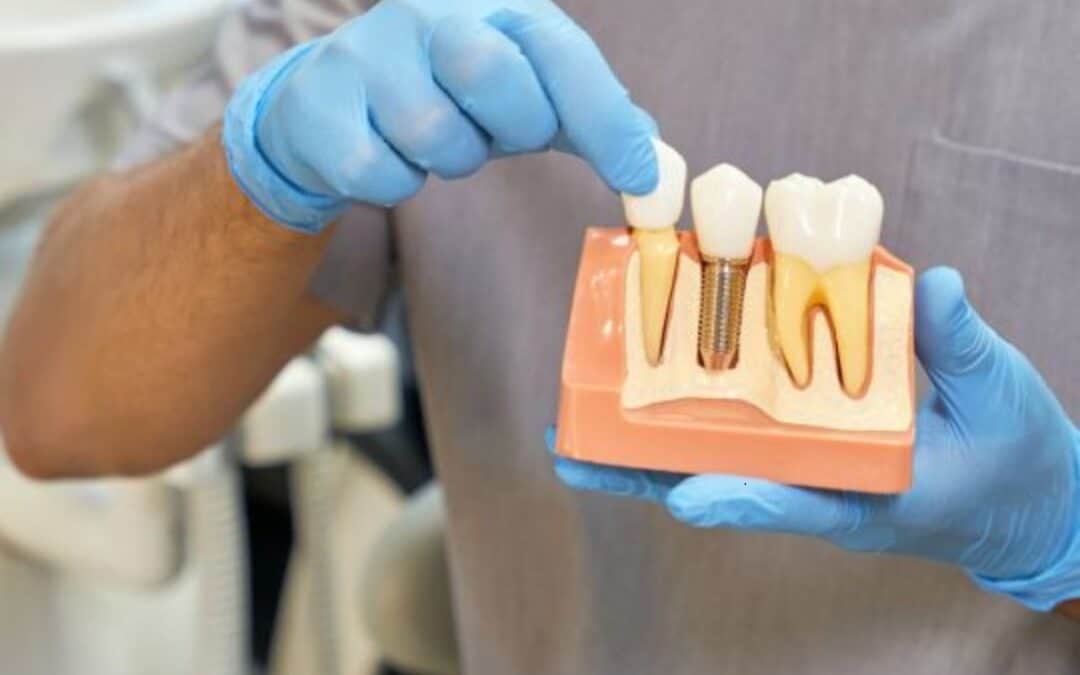 Dental Implants vs. Dentures: Which Is Right for You in Chandler?