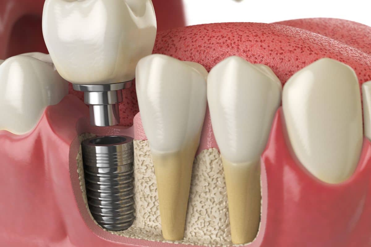 dental implants chandler