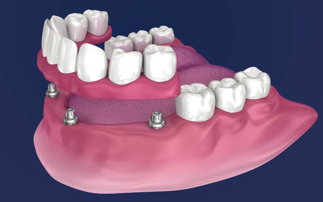 The Benefits of  All-on-4 Dental Implants