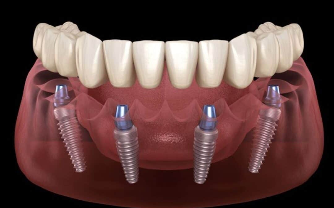 Why Choose All-on-4 Dental Implants Over Traditional Dentures?