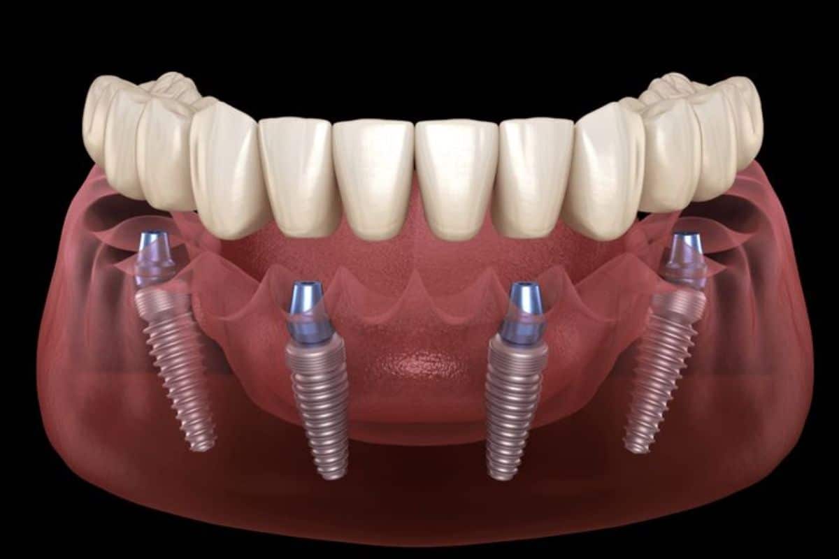 all on 4 dental implants chandler