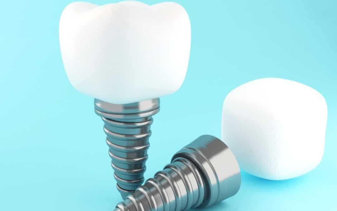 The Crucial Role Of Dental Implants In Rebuilding Your Smile