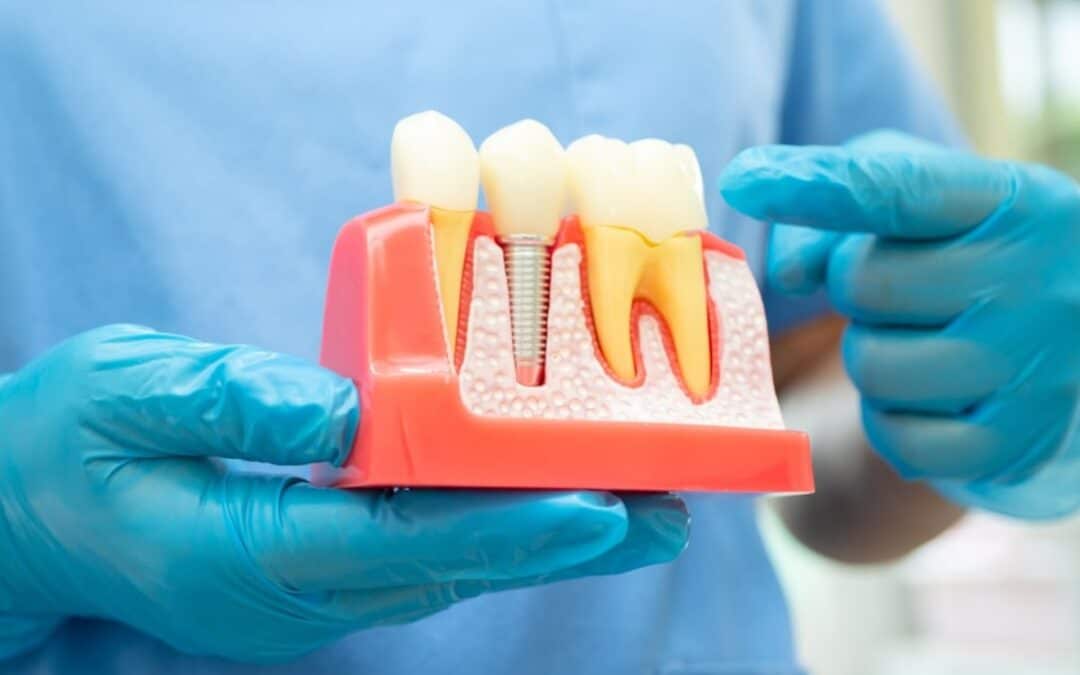 Stop Feeling Embarrassed About Your Smile And Fix It With Dental Implants!