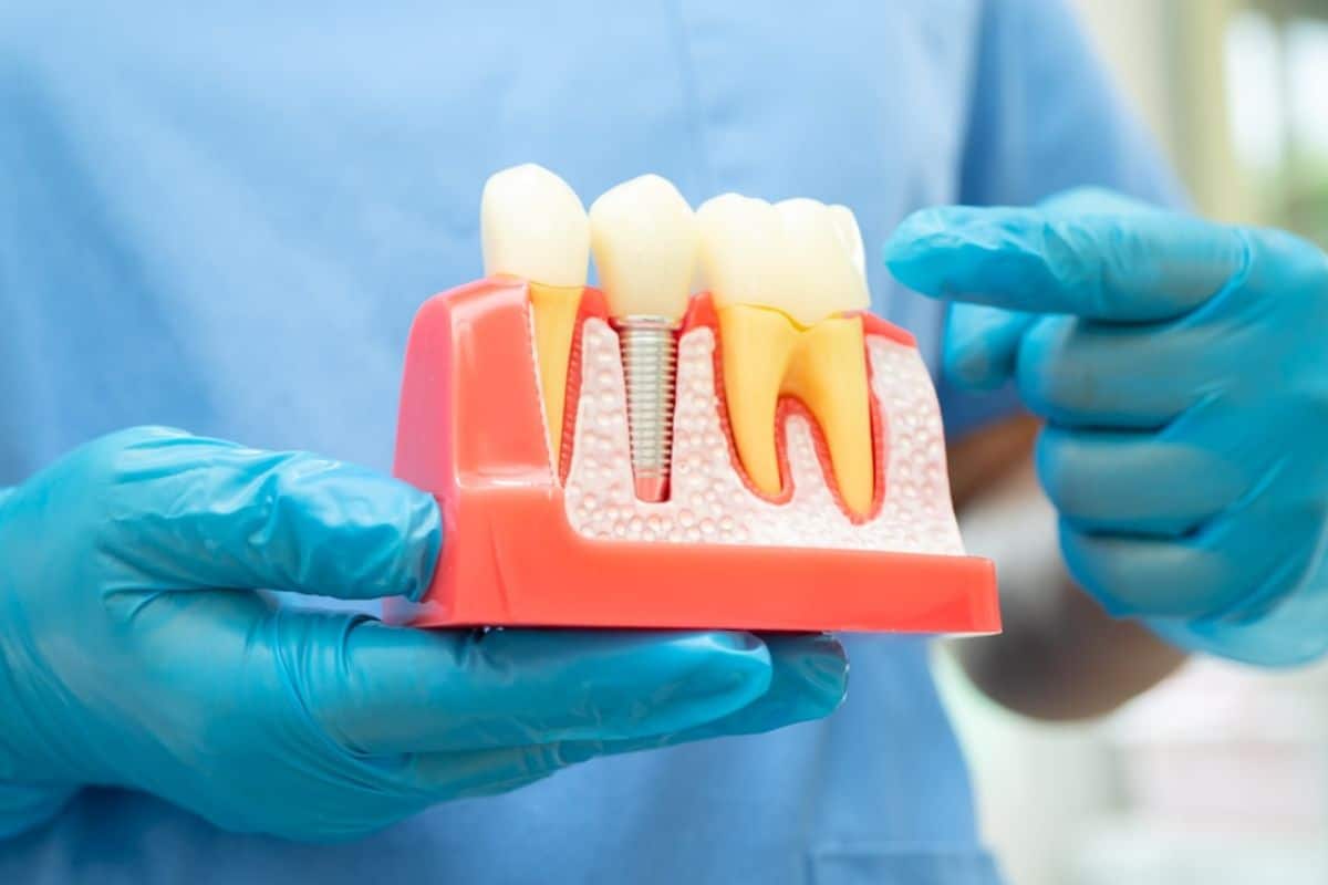 Dental Implants in Chandler