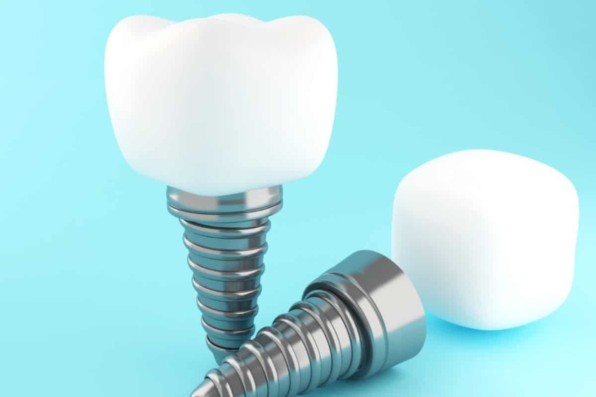 dental implants chandler