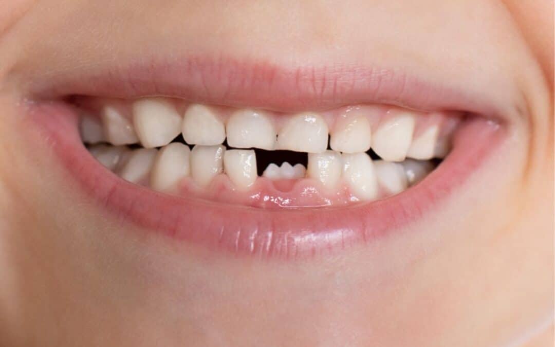 What Should I Do If My Tooth Gets Knocked Out?