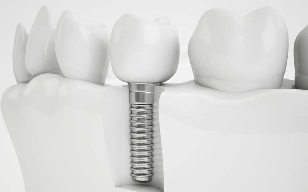 What Are the Consequences of Not Replacing a Missing Tooth?