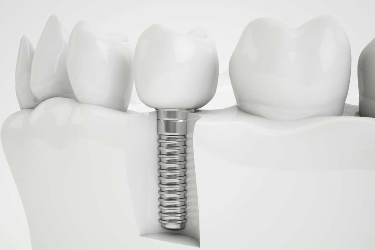dental implants in Chandler