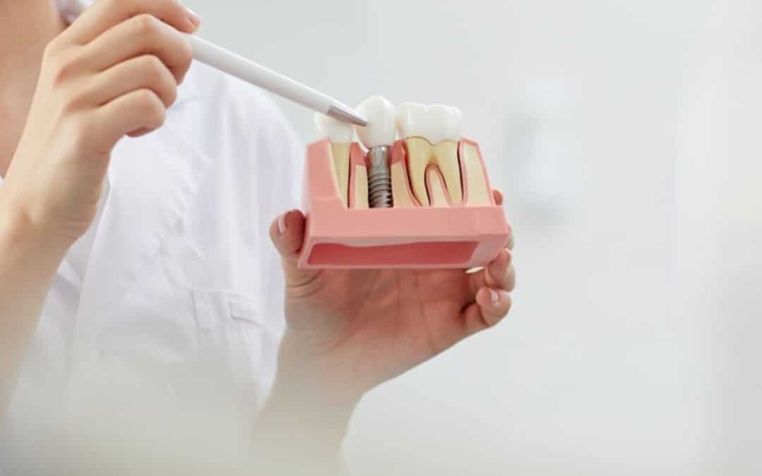 How Long Does A Tooth Implant Take To Fully Heal?