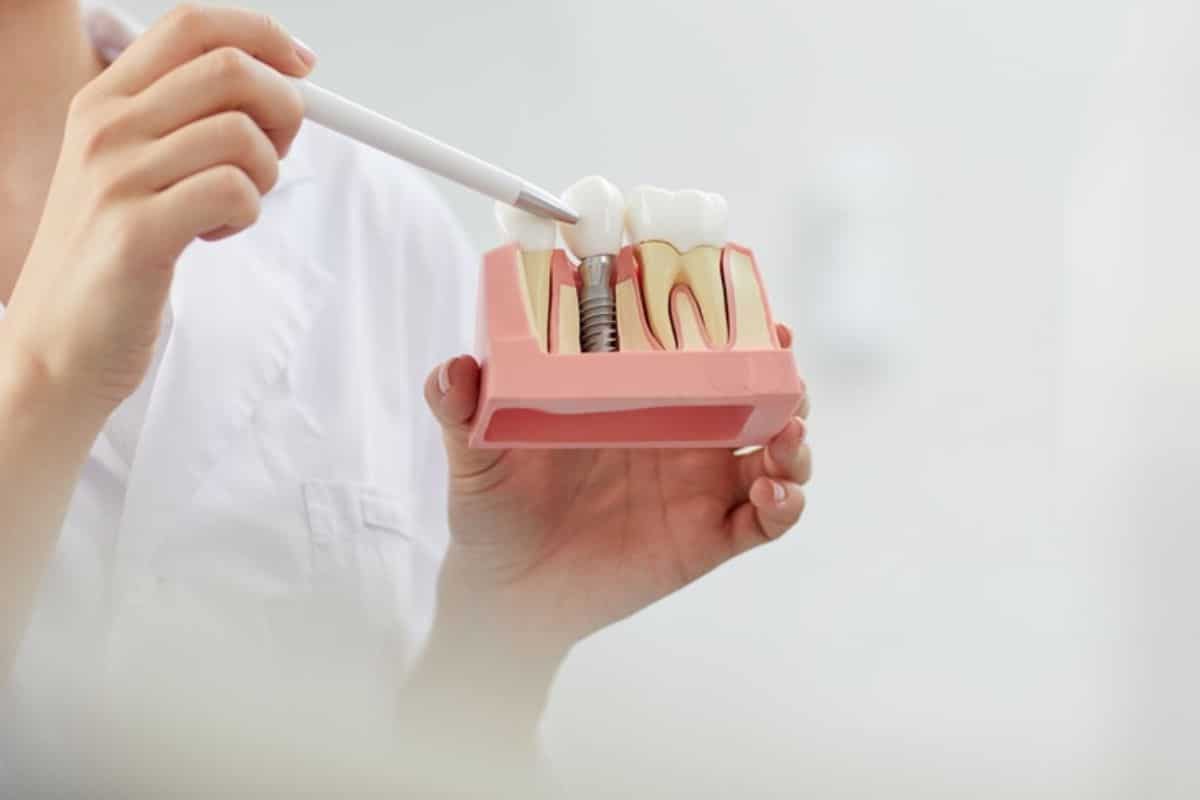 Dental implants chandler