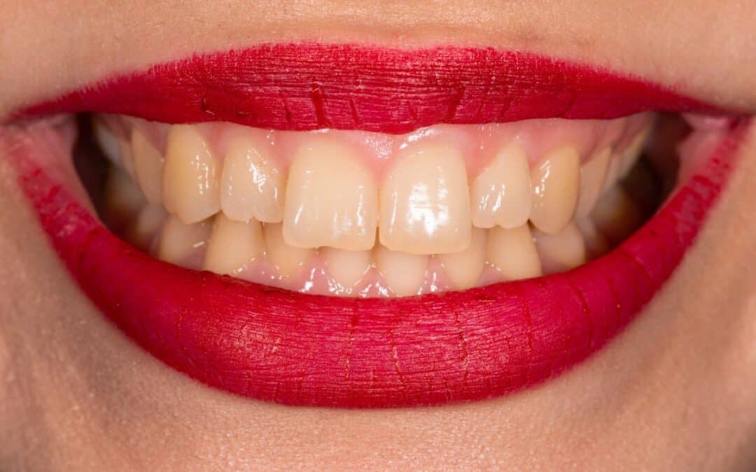 Why are my Teeth Yellow When I Brush Them Every Day?