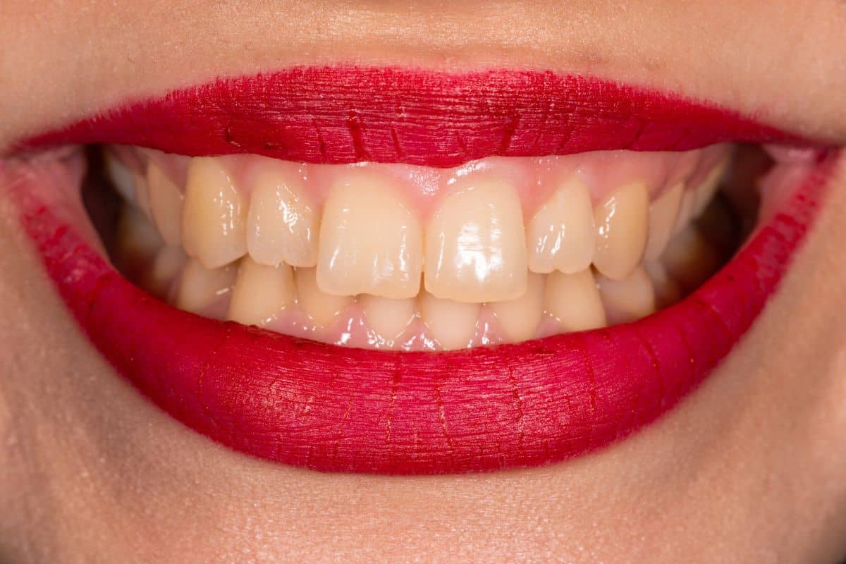 Teeth whitening in chandler