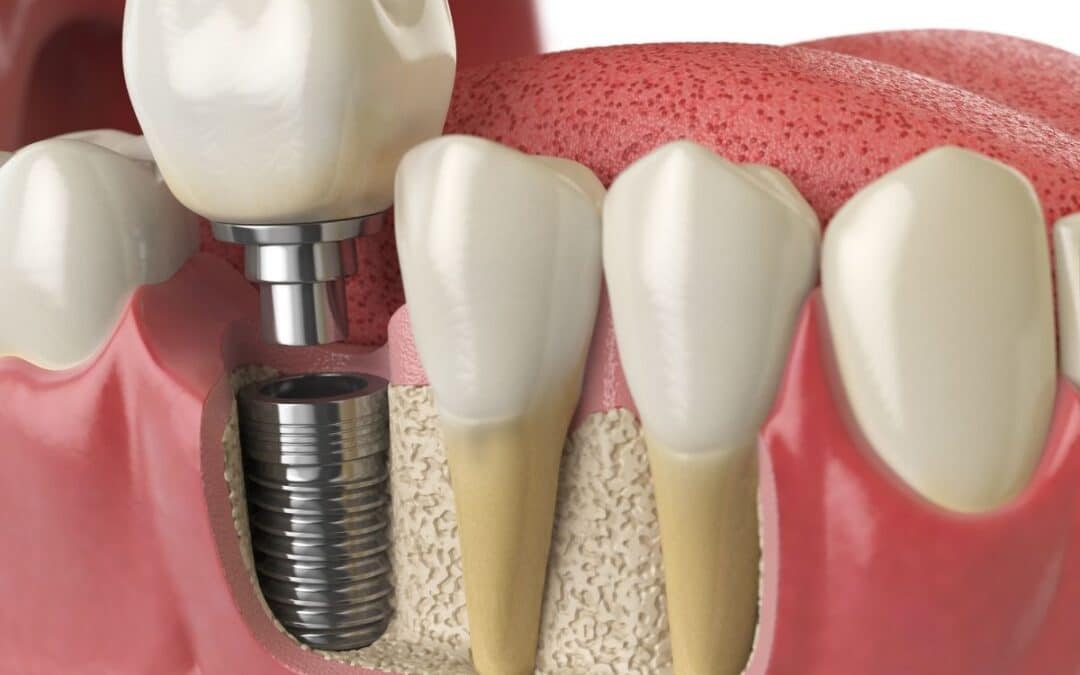 Your Personal Guide To A Dental Implant Journey With A Chandler Expert