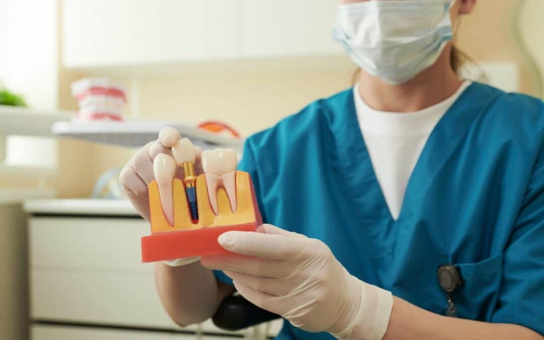How to Care for Your Dental Implants: Expert Tips