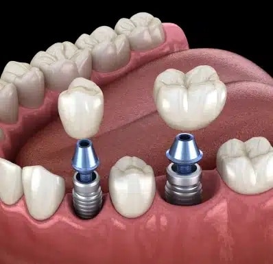 Natural Looking Smile with Dental Implants Chandler