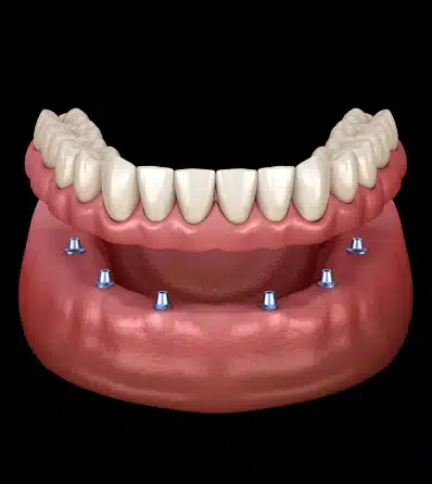 Dental implants in Chandler