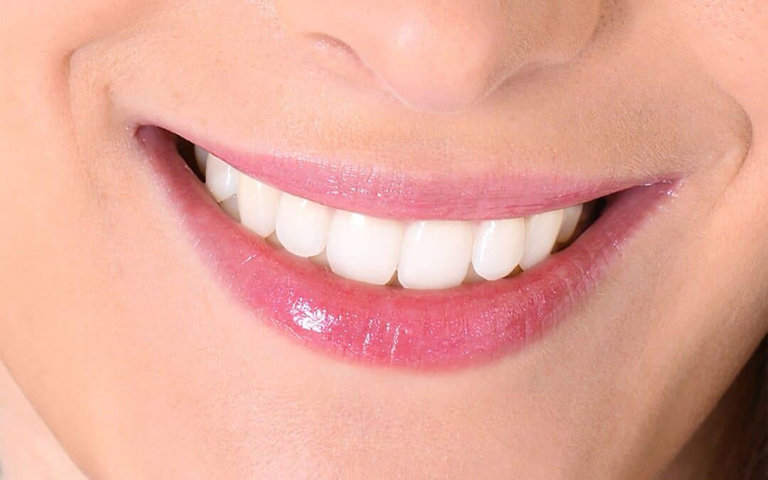 Foods to Avoid After Teeth Whitening: Chandler Experts Share Tips