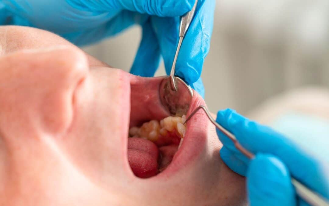 Natural Remedies to Relieve Tooth Abscess Swelling Before Your Dental Appointment