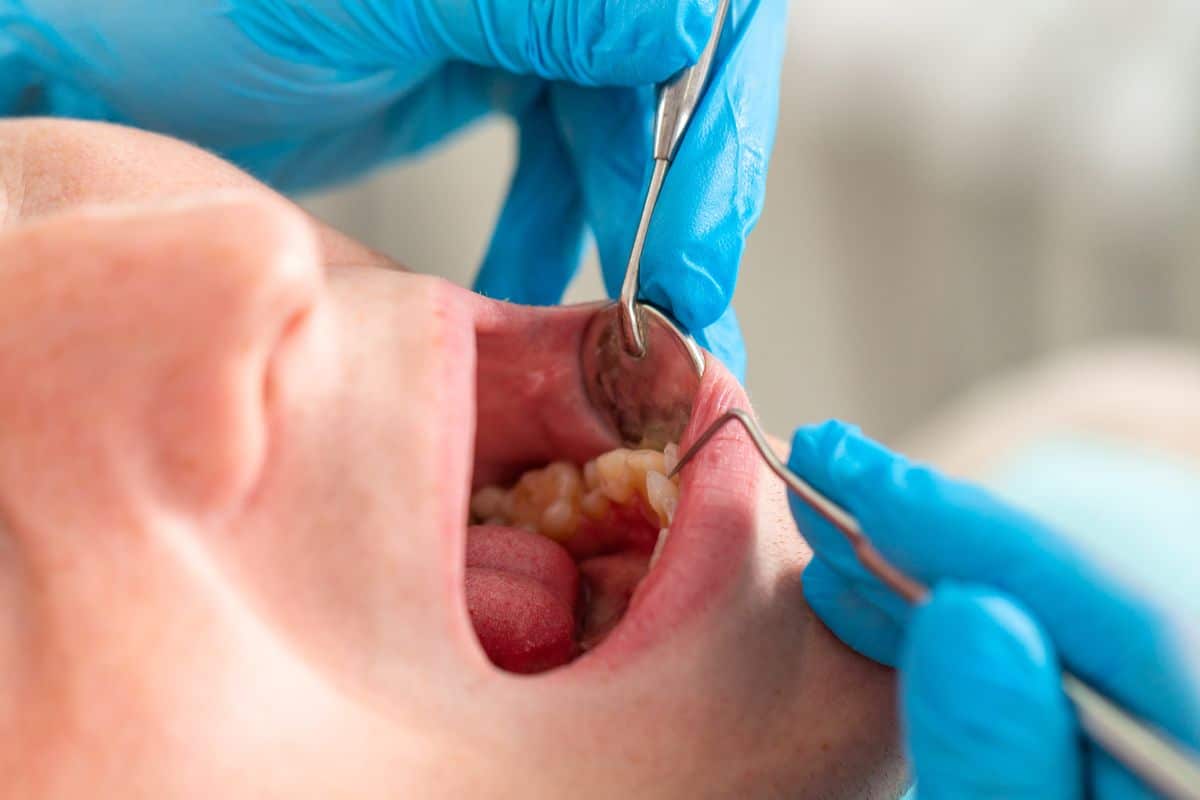 Relieve Tooth Abscess Swelling Before Your Dental Appointment
