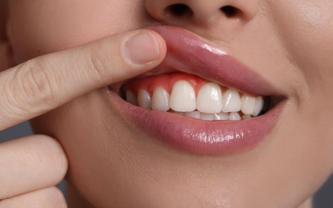 Bleeding Gums? Here’s Why Salt Water Might Be The First Step To Relief