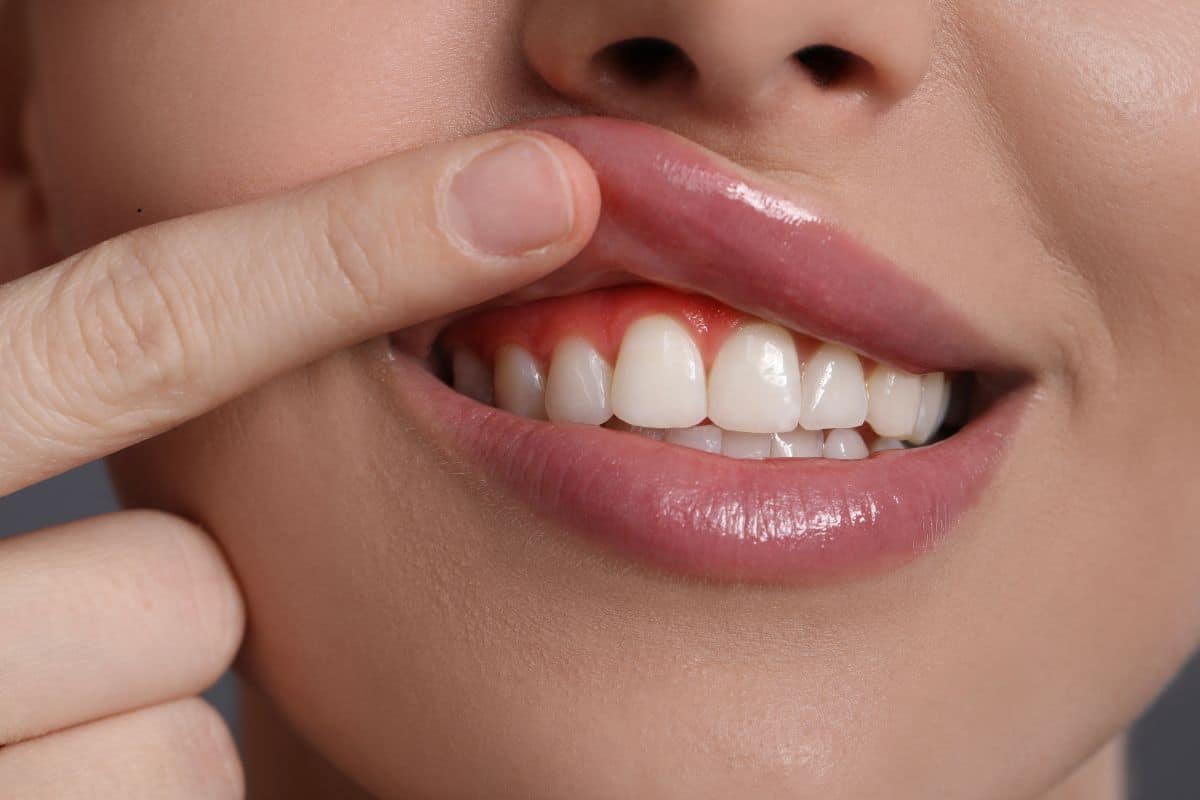 easy solution for gum before reaching out to a dentist in Chandler
