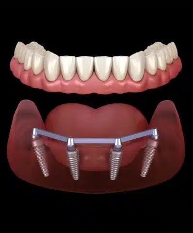 exploring all on 4 dental implants Chandler