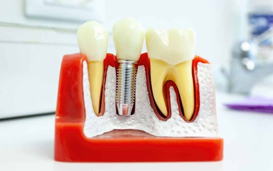 Maintain Your Dental Implants for Life: Tips for Chandler Residents