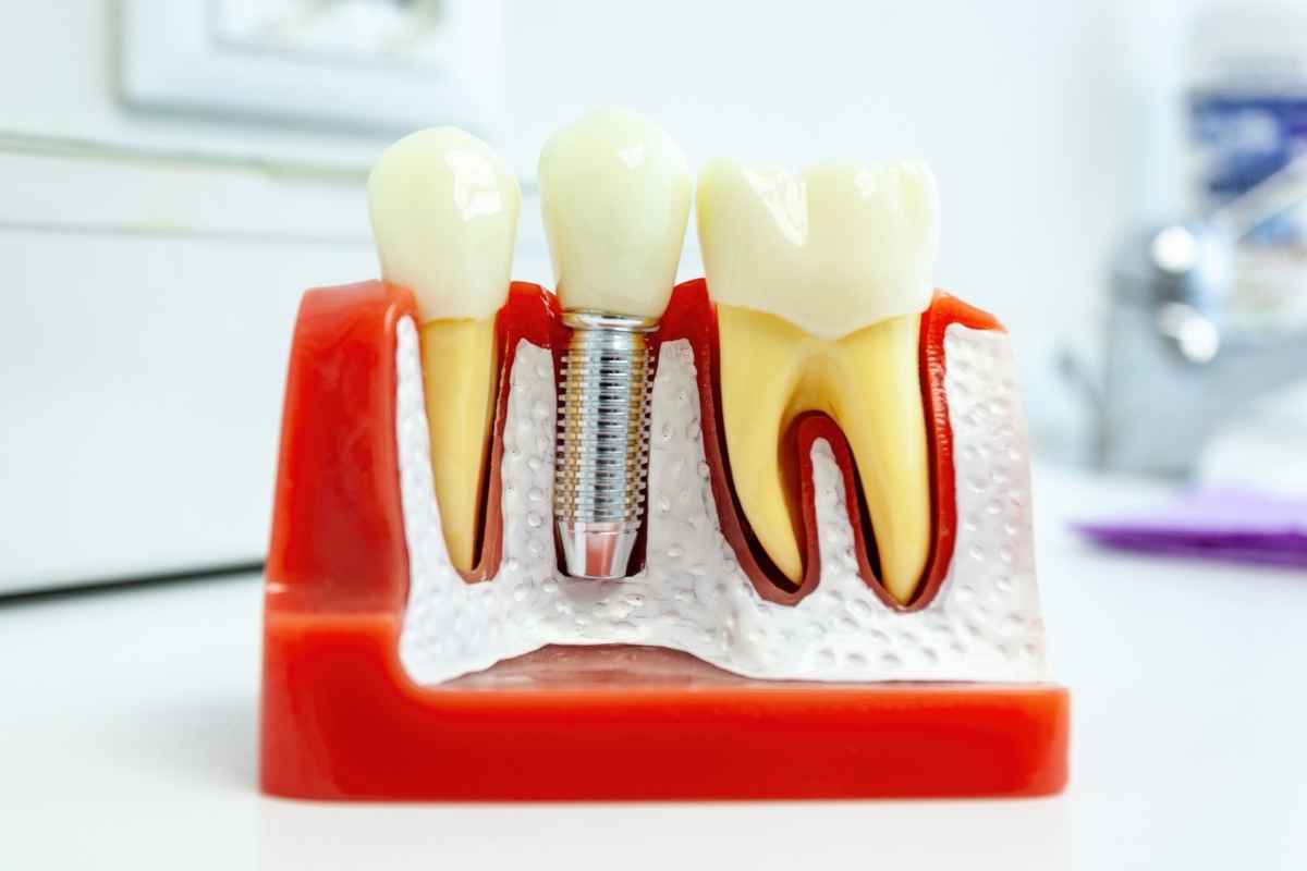 maintain your dental Implants Chandler for Life long